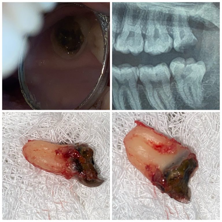Dr Shriti Agarwal ,BDS , Tooth Extraction Case