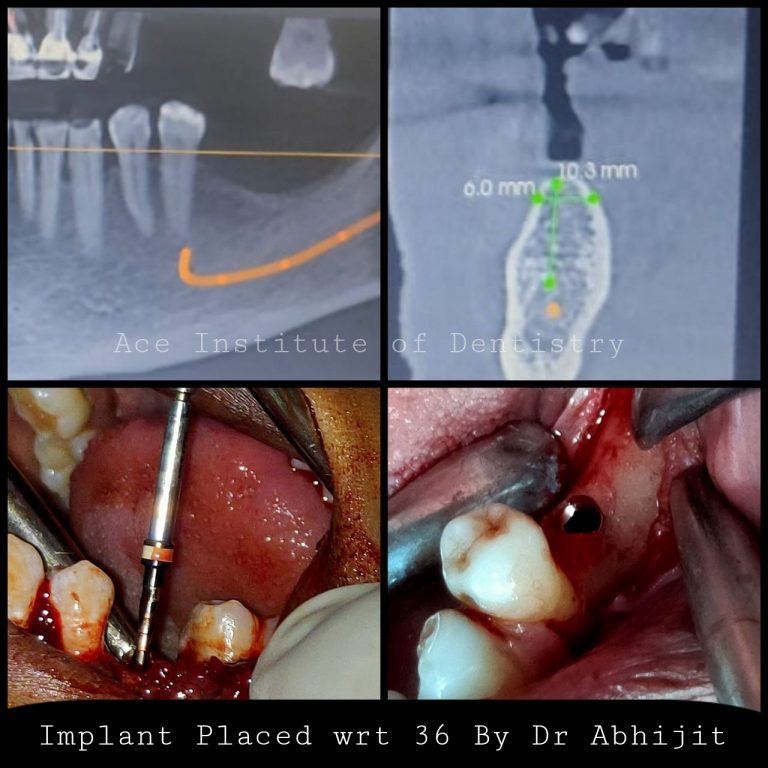 Learn Implant Dentistry, Ace Institute of Dentistry