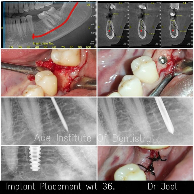 Learn Implant Dentistry, Ace Institute of Dentistry