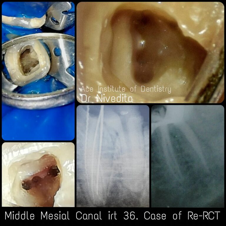 How to do root canals? Learn root canals